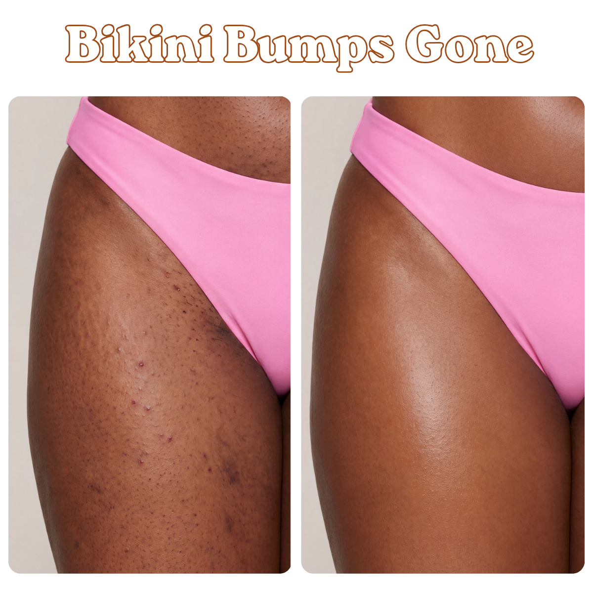 Pretty Kitty Oil- FOR INGROWN HAIRS, DARK MARKS & SCARS